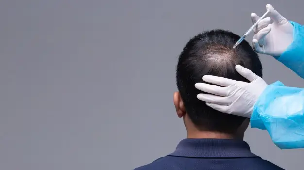 PRP Hair Loss for Men